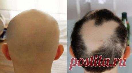 Препарат от артрита возвращает волосы лысым мужчинам — Рамблер/новости