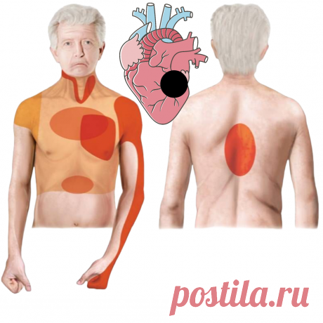 Прединфарктные симптомы. Должен знать каждый! | Записки Фармацевта | Дзен
