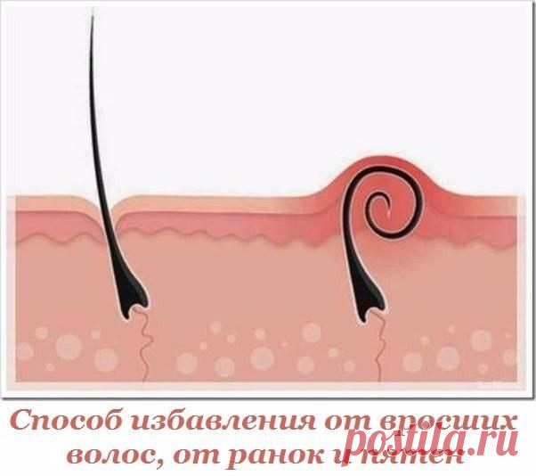 СПОСОБ ИЗБАВЛЕНИЯ ОТ ВРОСШИХ ВОЛОС,РАНОК И ПЯТЕН.