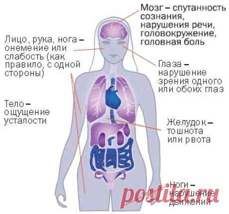 Как распознавать первые признаки инсульта.