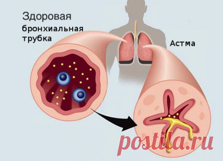 10 продуктов против астмы