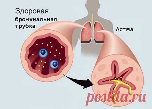10 продуктов против астмы