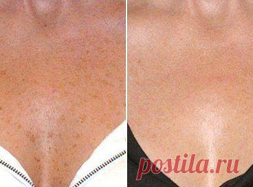 КАК ИЗБАВИТСЯ ОТ ПИГМЕНТНЫХ ПЯТЕН 

Рассказываю, что помогло мне! Этот чудо способ народной медицины спас меня от ужасных пятен и сделал на 5 лет моложе! Девочки, записывайте! Гарантирую, это работает: 

Подробнее: http://www.odnoklassniki.ru/womens.book
•••подробнее