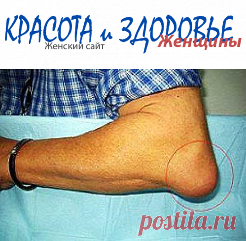 #Бурсит_локтевого_сустава: симптомы и лечение
Бурсит локтевого сустава – это воспалительный процесс в области бурсы локтя. В общем, бурса (так называемая сумочка) является маленьким мешочком, который заполнен жидкостью, функционирующим в качестве поверхности скольжения для снижения трений между костью и мягкими тканями организма