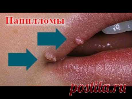 Папилломы исчезнут БЕЗ СЛЕДА! КАК я удалила папиллому  РАЗ и НАВСЕГДА! БЕЗОПАСНО и ЭФФЕКТИВНО !