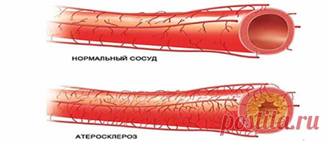 Диагностика и лечение стеноза сосудов нижних конечностей Причины сужения сосудов ног. Симптомы и диагностика стеноза артерий нижних конечностей. Лечение медикаментами, народными средствами, хирургическим методом.