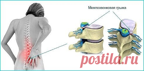 ПОЯСНИЧНАЯ ГРЫЖА ЛЕЧИТСЯ НАРОДНЫМИ СПОСОБАМИ
Поясничная грыжа – это болезнь серьезная! Поясничная грыжа может «напасть», как на молодого человека, так и на пенсионера. От возраста это совершенно не зависит. Люди с поясничной грыжей встречаются и двадцатилетние, и шестидесяти пятилетние.
Показать полностью…
Поясничная грыжа доставляет очень большие страдания. Постоянная боль не дает нормально жить! Даже шагнув на одну ступеньку, уже хочется вскрикнуть от боли, что уже говор...