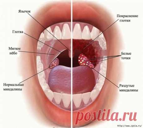 Как промыть миндалины в домашних условиях?