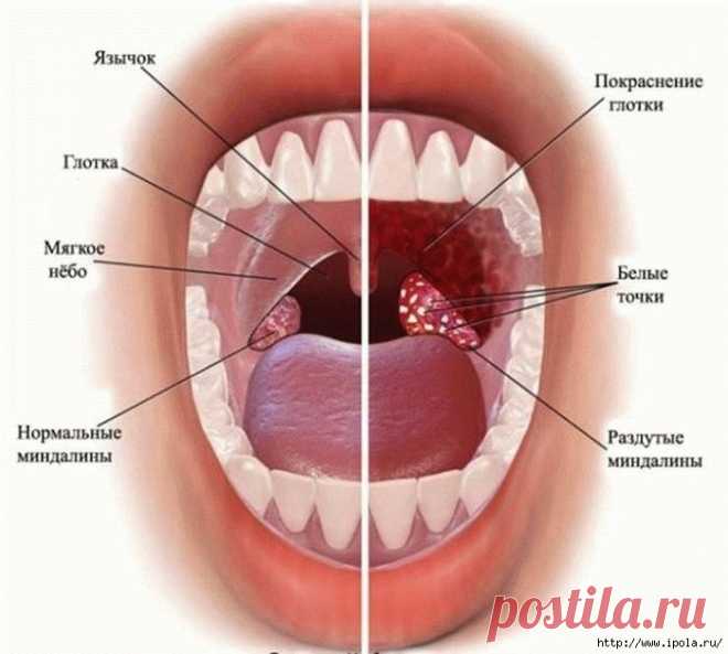 Как промыть миндалины в домашних условиях?
