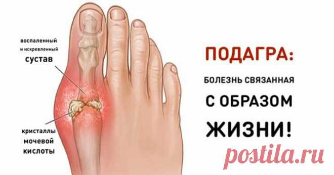 Подагра: болезнь, связанная с образом жизни. Читать каждому! - Все обо Всем Подагра: болезнь, связанная с образом жизни. Читать каждому! Уровень мочевой кислоты повышен зачастую и у людей с высоким кровяным давлением, избыточным весом, а также с заболеваниями почек. Показатели подагры стремительно растут в Великобритании, достигнув 64 процентов за период 1997-2012 гг. Это означает рост примерно на четыре процента каждый год, и от этого болезненного состояния сейчас страдает …
