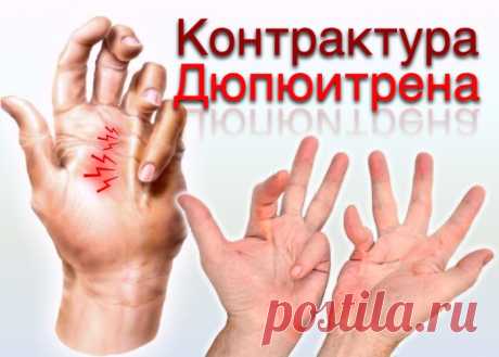 Контрактура Дюпюитрена: причины, симптомы, диагностика, лечение - ПолонСил.ру - социальная сеть здоровья - медиаплатформа МирТесен