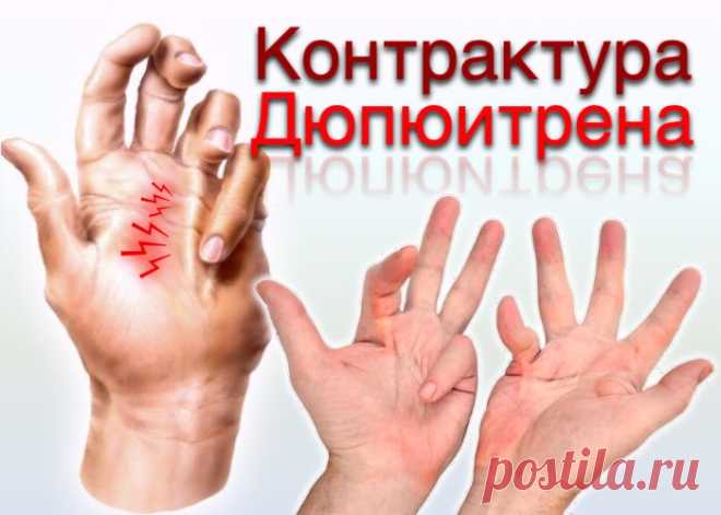 Контрактура Дюпюитрена: причины, симптомы, диагностика, лечение - ПолонСил.ру - социальная сеть здоровья - медиаплатформа МирТесен