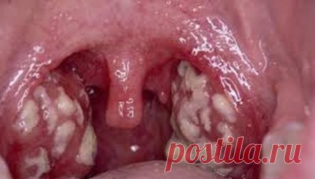 Избавьтесь от инфекции горла в течении нескольких часов! Есть много причин для ангины — вирусные инфекции, бактериальные инфекции или некоторые проблемы со здоровьем. Инфекция в нашей респираторной системе проявляется через гной в горле, которые могут возни…