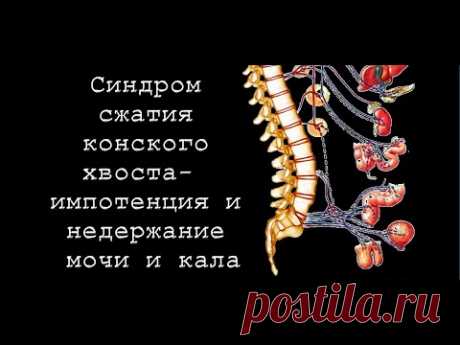 Синдром сжатия конского хвоста-  импотенция и недержание мочи и кала