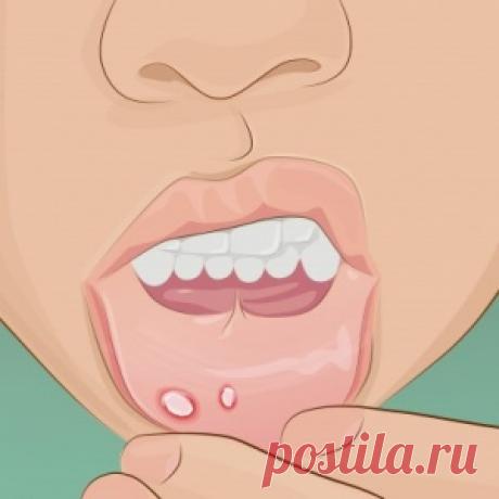 Восемь способов избавиться от простуды на губах за один день