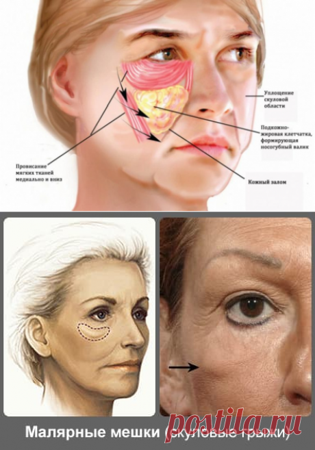Как убрать малярные мешки на скулах и под глазами - Meso Face