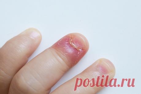 ПАНАРИЦИЙ

Хочу поделиться рецептам от панариция.Сама я медик, работала в
детской консультации, потом в физиотерапии. Однажды, помогая делать
прививки в детсаду, услышала от пожилой медсестры: "Запомни рецепт от
панариция, я чуть ногу не потеряла, а он меня на ноги поставил за 2 дня.
Ступню раздуло, палец почернел, ни спать, ни есть не могла". Вроде оно
тогда мне и ни к чему было, но запомнила.

30 минут держать конечность в растворе марганцовки бледно-розового
цвета.
30 м...