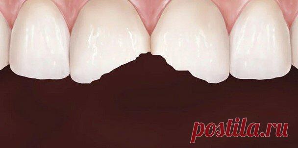 Откололся передний зуб. Как его можно восстановить?
🔎 Коротко Все зависит от степени разрушения зуба. Если скол в пределах эмали, острые края зуба достаточно пришлифовать. В остальных случаях работает правило: если коронковая часть зуба разрушена менее чем наполовину, зуб восстанавливают композитным материалом или покрывают виниром. А при разрушении более чем наполовину необходима искусственная...
Читай пост далее на сайте. Жми ⏫ссылку выше
