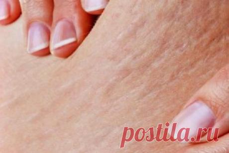 Домашний крем от растяжек | Крема, скрабы, лосьоны, шампуни своими руками | Само Совершенство