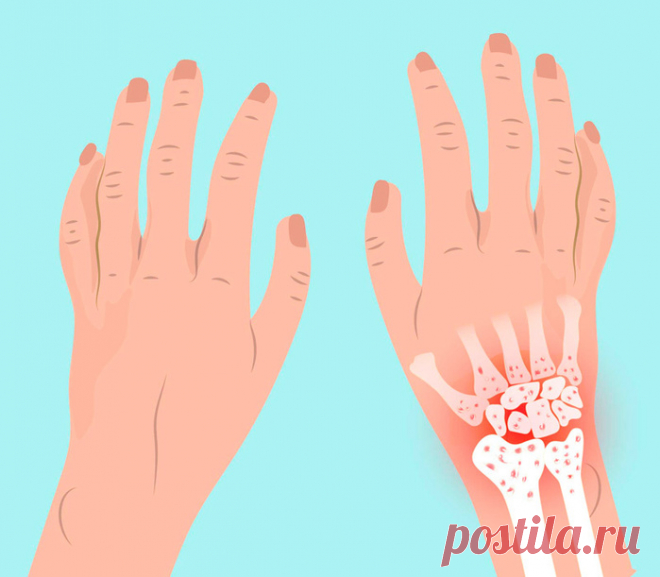 Травы и добавки для лечения ревматоидного артрита