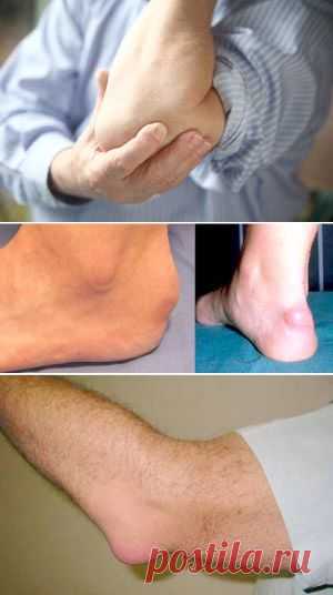 Бурсит тазобедренного, локтевого, плечевого, коленного, пяточного суставов, симптомы и причины. Лечение бурсита и профилактика