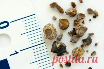 Очищение почек от песка – современные методы
