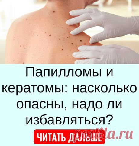Папилломы и кератомы: насколько опасны, надо ли избавляться?