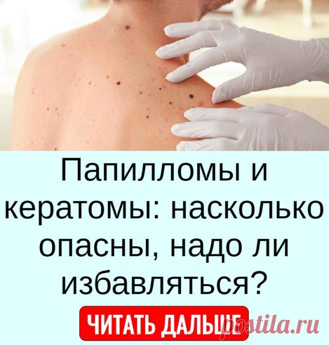 Папилломы и кератомы: насколько опасны, надо ли избавляться?