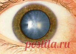 Лечим катаракту с помощью ростков картофеля. народный метод лечения, лечение в домашних условиях