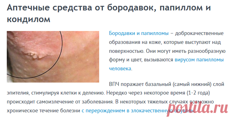 Аптечные препараты помогающие избавиться от бородавок, папиллом и кондилом
При появлении бородавок, папиллом и кондилом, можно пойти щадящим путем и попытаться избавиться от доброкачественных новообразований с помощью аптечных средств.