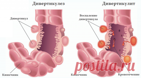 Дивертикулит - симптомы, лечение, причины, диагностика