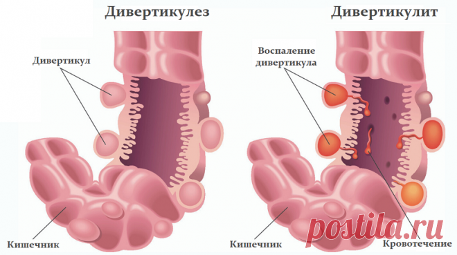 Дивертикулит - симптомы, лечение, причины, диагностика