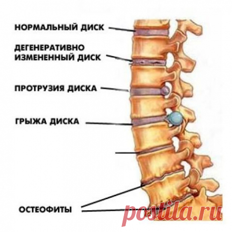 Настои, мази от остеохондроза | Женский журнал