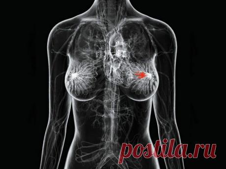 Основные причины рака груди, о которых вам стоит знать.
Все, что вам нужно для того, чтобы намного снизить вероятность заболеть раком груди — знание об основных причинах его возникновения. Вам стоит знать о них и ради собственного блага, и ради того, чтобы вы могли поделиться ею с подругами и родственниками.