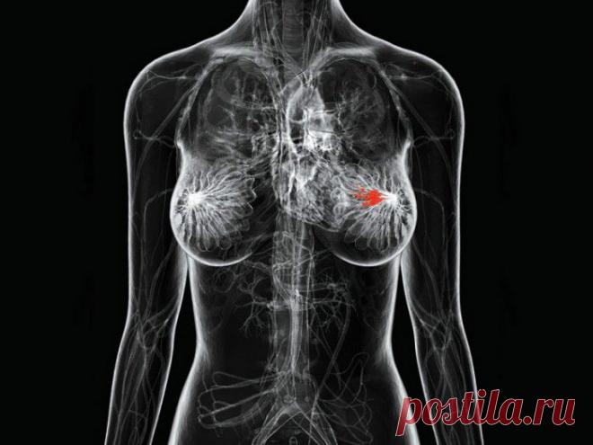 Основные причины рака груди, о которых вам стоит знать.
Все, что вам нужно для того, чтобы намного снизить вероятность заболеть раком груди — знание об основных причинах его возникновения. Вам стоит знать о них и ради собственного блага, и ради того, чтобы вы могли поделиться ею с подругами и родственниками.