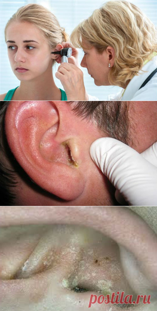 Псориаз в ушах, классификация, диагностика, лечение