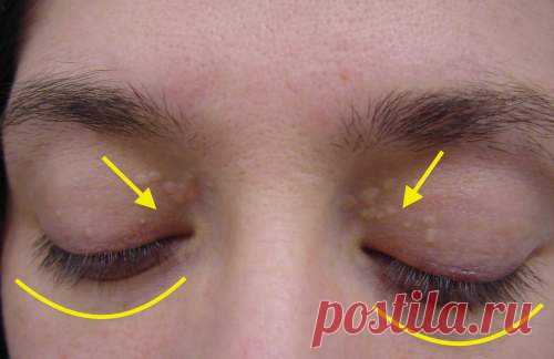 Вы можете быстро и просто избавиться от ксантелазм! 9 самых мощных средств! Эти простые средства действуют мягко и эффективно! Только те, у кого есть ксантелазма, знают, как она раздражает. Это слегка