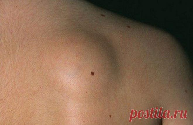 Чем Опасна Липома На Спине? Липома представляет собой плотное поверхностное образование наподобие бугорка, которое при пальпации (ощупывании) не вызывает болезненных ощущений. Внутренним содержимым жировика является субстрат жировой ткани, находящийся в своеобразной капсуле. Поэтому такое липидное скопление не соприкасается с окружающими тканями, а сама опухоль лишена возможности метастазировать в близлежащие органы.