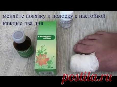 Как вылечить вросший ноготь дома без операции, без удаления