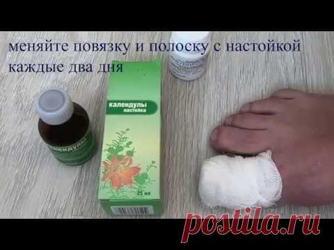 Как вылечить вросший ноготь дома без операции, без удаления