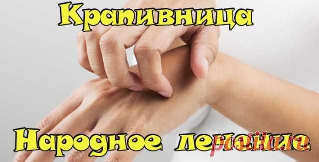 Крапивница народное лечение | Народная медицина