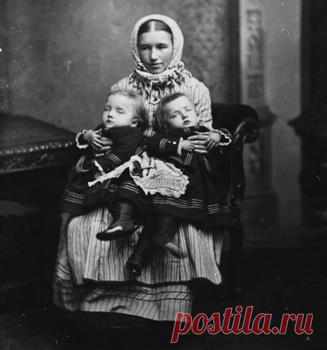 Беременность на двоих: история сиамских близнецов, одна из которых стала мамой | Мел