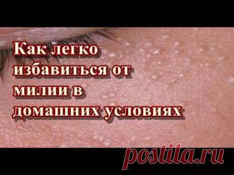 Народная медицина на страже вашего здоровья. Милиа, также называемая молочными пятнами, — это маленькие белые или желтоватые шишки, которые обычно появляются...