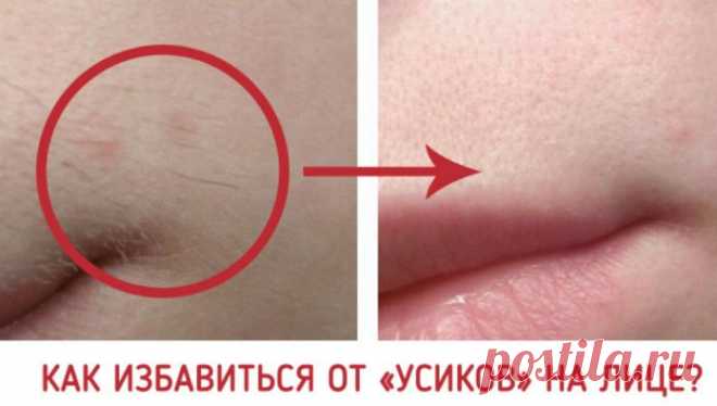 Как избавиться от «усиков» на лице? 
=
    1 столовая ложка овсяной пасты. Для ее приготовления размешайте 1/2 чайной ложки овсянки, 6-8 капель лимонного сока и 1 столовую ложку меда.
    2 столовые ложки меда.
    2 столовые ложки лимонного сока.