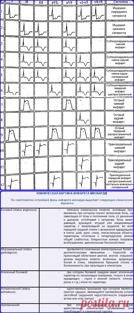 • ЭКГ признаки инфаркта миокарда - Шпаргалки для 