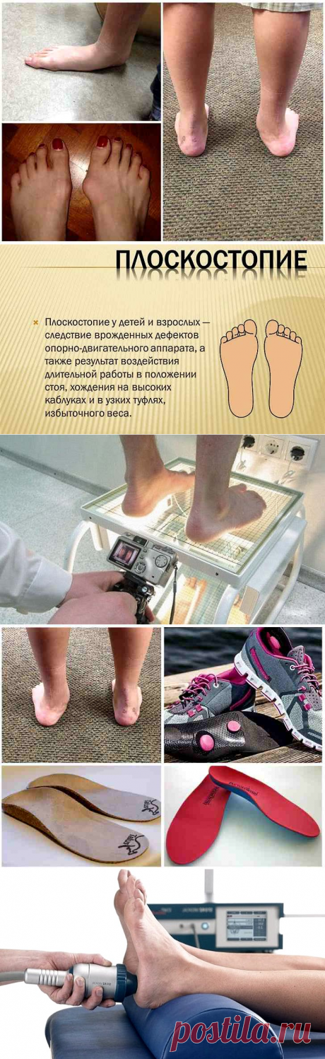 Плоскостопие причины профилактика и методы лечения. Советы хирурга
Плоскостопием страдают до 50% населения земли. Женщины подвержены этому заболеванию в 4 раза больше чем мужчины. В 3% случаев плоскостопие регистрируется с самого рождения, к 2-ум годам у 24% детей, к 4-ем у 32% детей, к семи годам у 40% детей, уже после 11 лет половина подростков страдает плоскостопием.