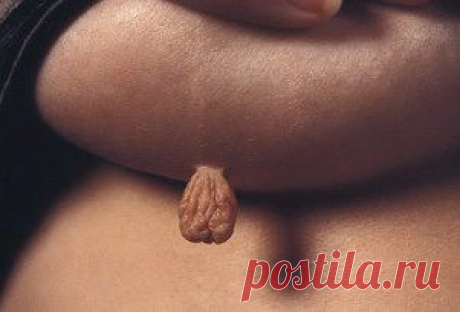 КАК  ИЗБАВИТЬСЯ  ОТ ПОПИЛЛОМ?