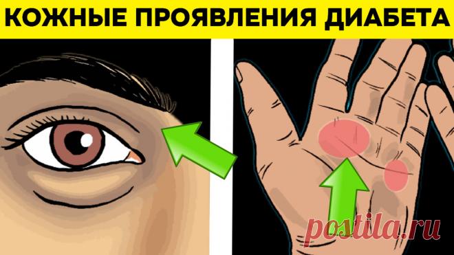 8 кожных проявлений сахарного диабета, которые многие из нас усердно игнорируют | Игорь Ботоговский | Дзен