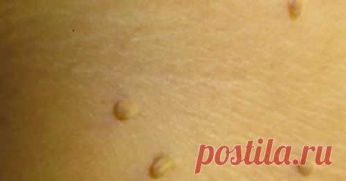 10 remedios naturales para eliminar las verrugas de tu cuerpo - Mejor Con Salud