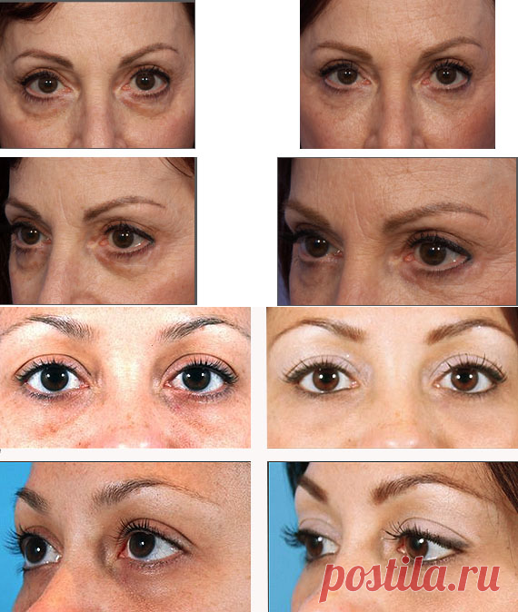 Коррекция слезной борозды и области вокруг глаз филлерами
